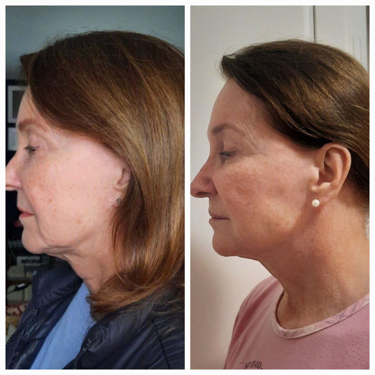 Depoimento antes e depois 2