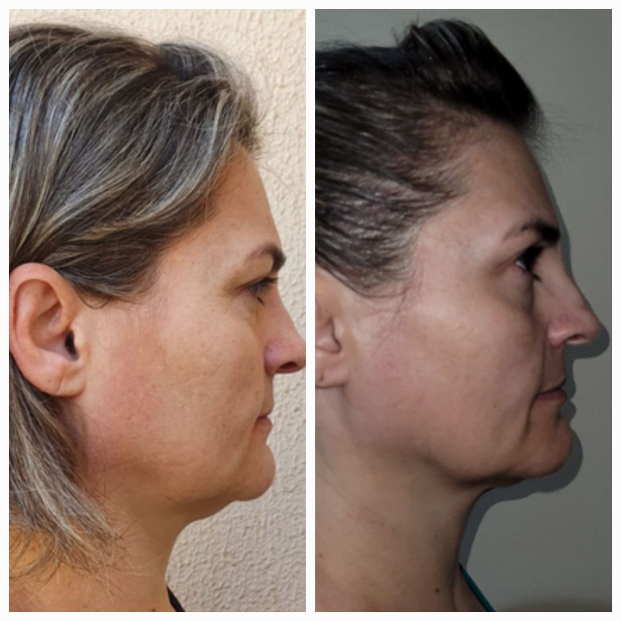 Depoimento antes e depois 3