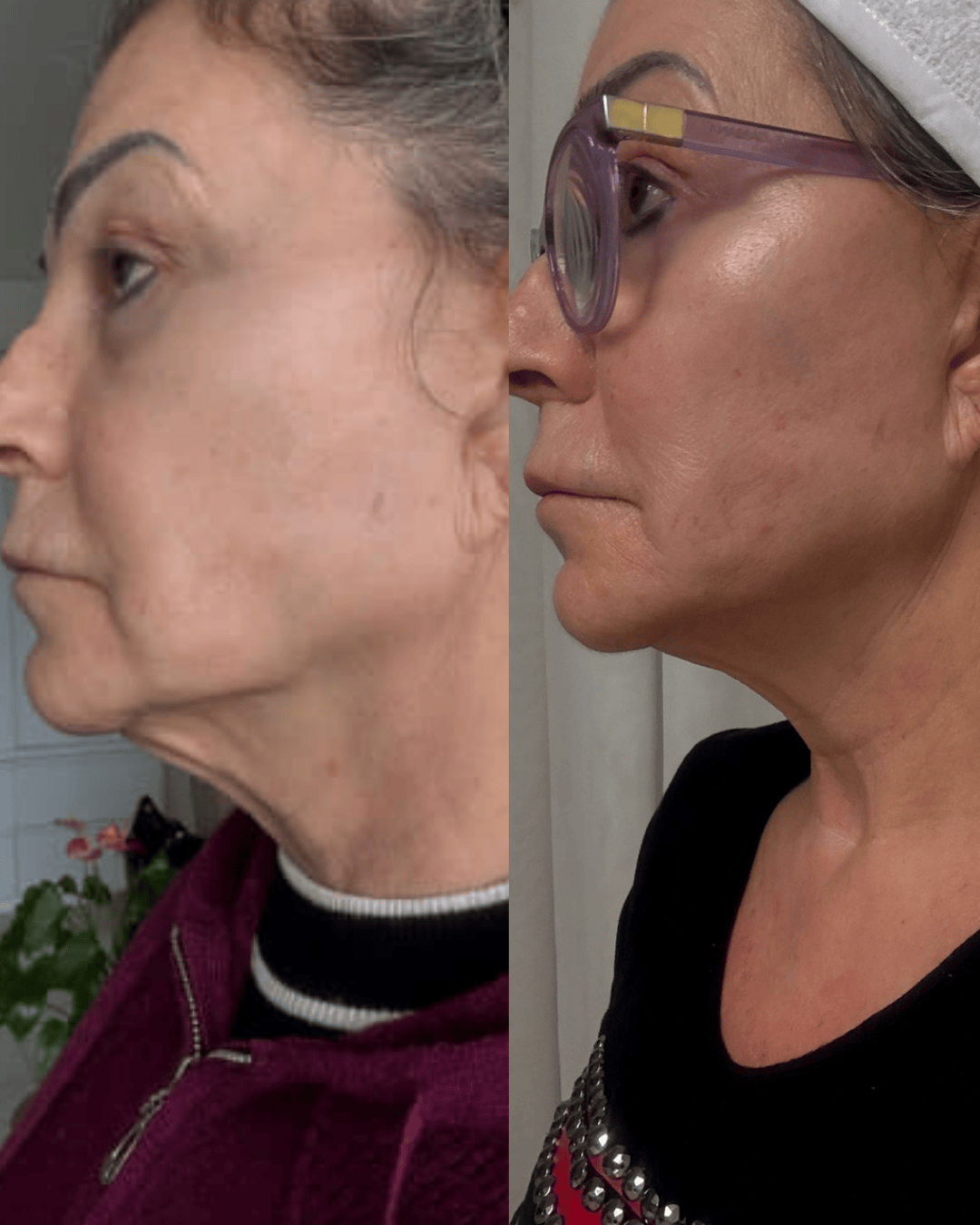 Resultado do protocolo Adeus Papada — antes e depois