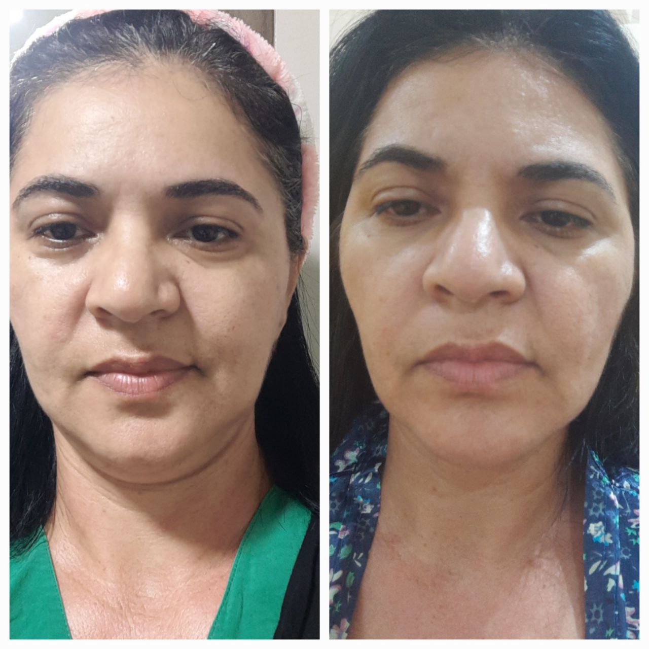 Resultado antes e depois da papada